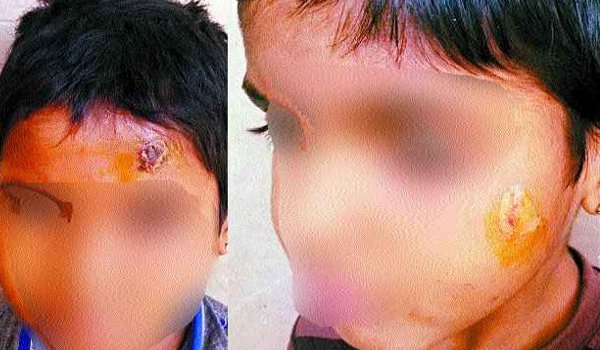 राजस्थान से लाए गए बाल मजदूरों को काम नहीं करने पर दागते थे मालिक! राजस्थान से लाए गए बाल मजदूरों को काम नहीं करने पर दागते थे मालिक!