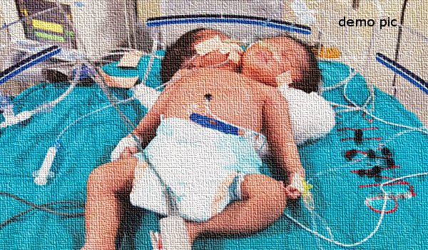दो सिर वाले बच्चे ने लिया रिम्स में जन्म, दो घंटे बाद मौत