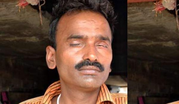 shocking news : angry wife glued husband's eyes by FEVICOL