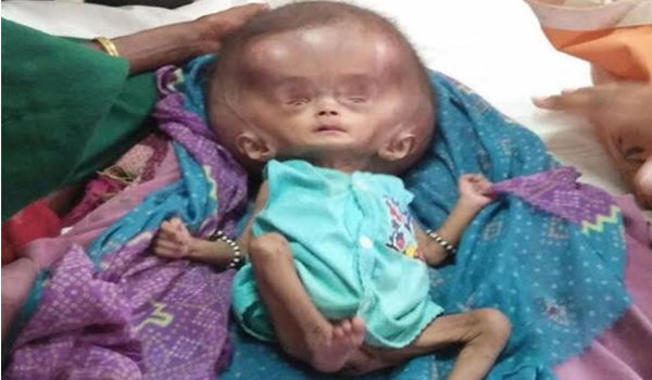 woman give alien type baby born at valsad and more treatment In Surat Civil Hospital