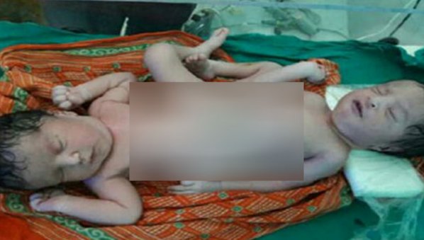 एक शरीर, दो धड़ : बिहार में पैदा हुआ दोमुंहा नवजात!