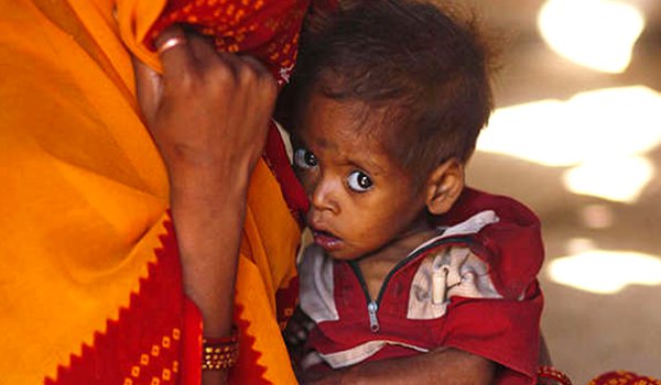 राजस्थान में 22 हजार बच्चे घातक कुपोषण के शिकार राजस्थान में 22 हजार बच्चे घातक कुपोषण के शिकार