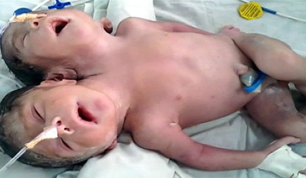 अजमेर के जनाना अस्पताल में जन्मा दो मुंह वाला नवजात