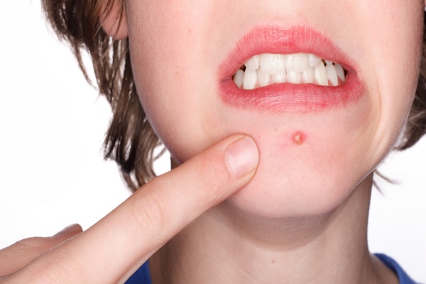 PIMPLES से परेशान हैं तो अपनाएं ये घरेलू उपाय PIMPLES से परेशान हैं तो अपनाएं ये घरेलू उपाय