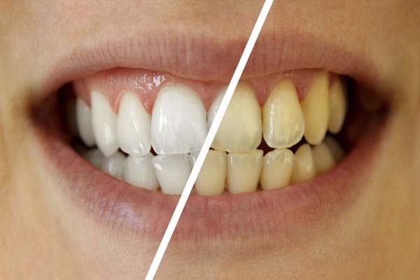 how to get rid from yellow teeth
