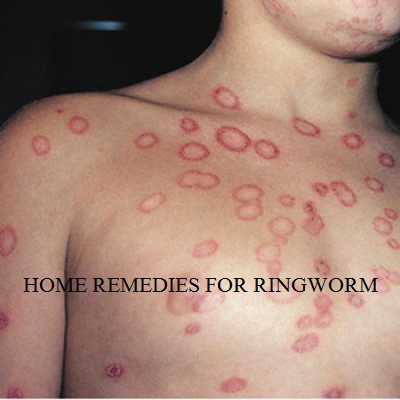 ringworm tratment sabguru.com