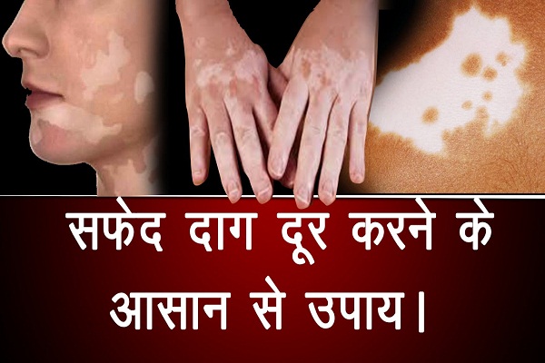 सफ़ेद दाग हटाने के लिए अपनाएं ये घरेलू टिप्स सफ़ेद दाग हटाने के लिए अपनाएं ये घरेलू टिप्स
