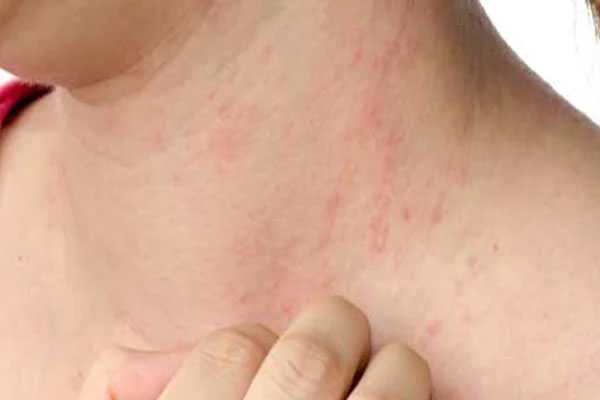 Remove skin allergies