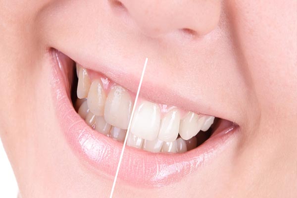 दांतो के पीलेपन को इन घरेलू उपचार से करे दूर