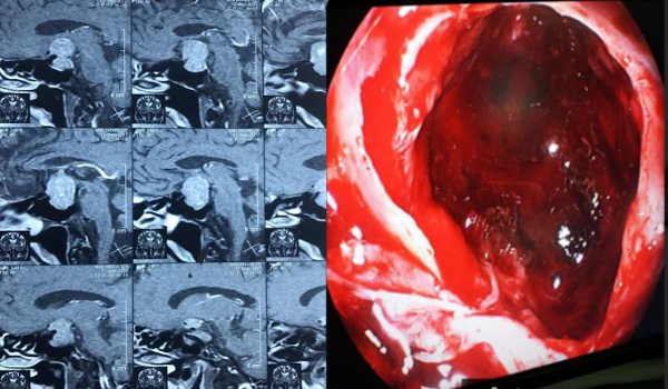 मित्तल हाॅस्पिटल में ब्रेन एन्यूरिज्म व ब्रेन ट्यूमर का सफल इलाज