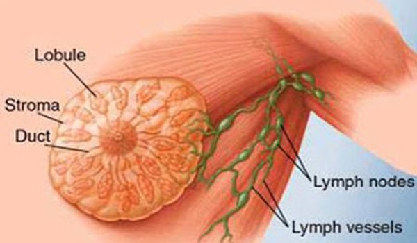 महिलाओं ही नहीं बल्कि पुरुषों को भी होता है ब्रेस्ट कैंसर