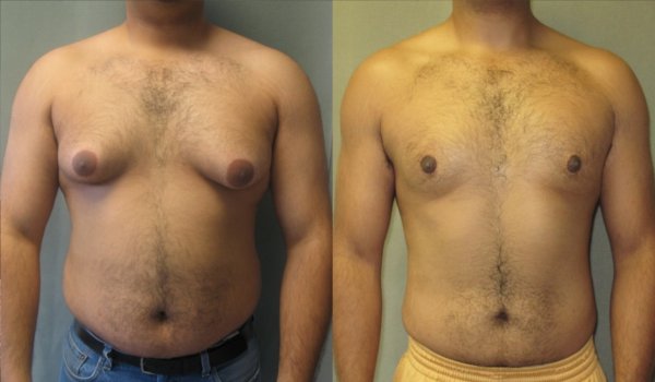 How to get rid of man boobs Fast & easiest Gynecomastia treatment