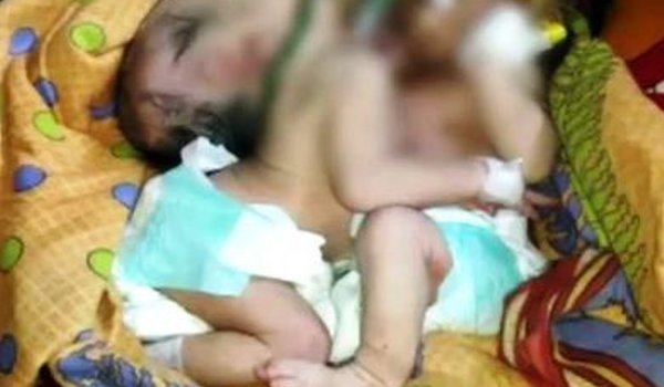 ओडिशा में एक-दूसरे से जुड़ी जुड़वां बच्चियों की मौत