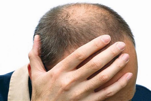 The problem of baldness is troubling, then these home remedies