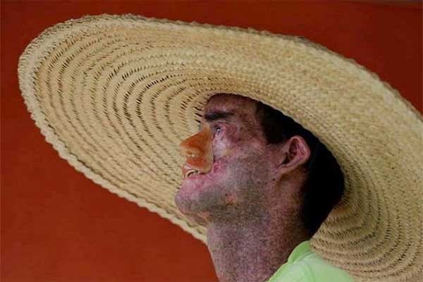 OMG! Skin disease