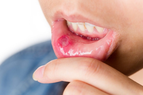 These home remedies will give you instant relief from mouth ulcers