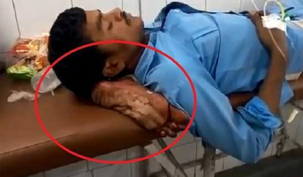 Jhansi hospital makes man lie with severed leg under head