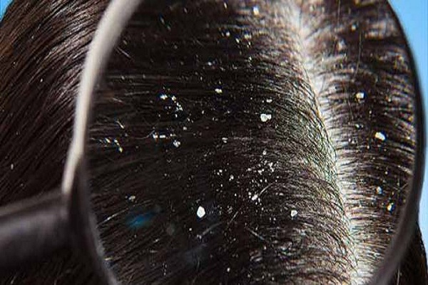 Home remedies to get rid of dandruff with garlic in hindi