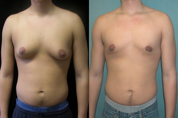 men rapidly growing breast tissue risk what is the reason in hindi