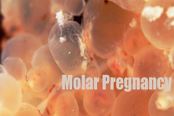 what moleor pregnancy and its treatment