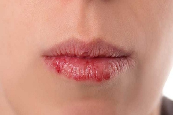 Home treatment swelling of lips