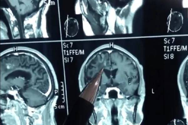 worm-lived-in-mans-brain-for-30-years-causing-headaches-and-seizures-in-china