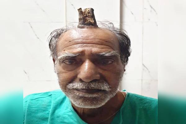 Man has 4-inch devil horn removed from head