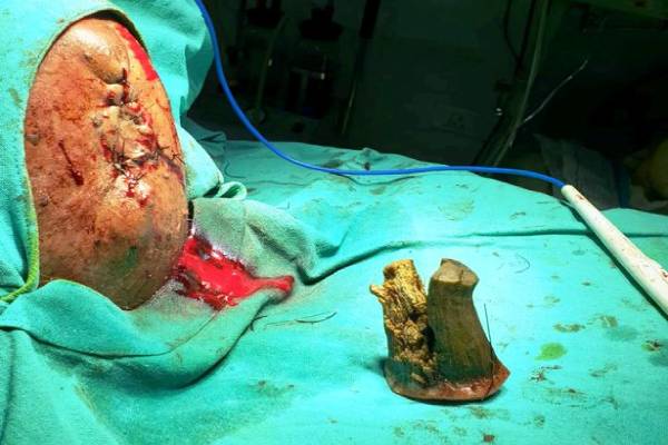 Man has 4-inch devil horn removed from head