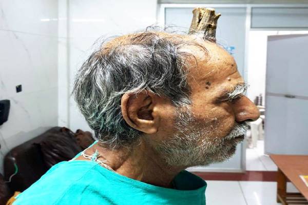Man has 4-inch devil horn removed from head
