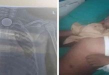 कोरबा में मुंह में सिक्का निगलने से आठ वर्षीय मासूम की मौत