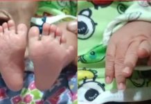 बैतूल में 24 उंगलियों के साथ जन्मी कुदरत की परी, डॉक्टर भी रह गए हैरान