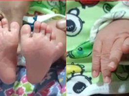 बैतूल में 24 उंगलियों के साथ जन्मी कुदरत की परी, डॉक्टर भी रह गए हैरान